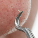 Cogit Pull open pinset for men [ Blackhead pin Set ] Washable Stainless Steel 1pc 日本Cogit双头祛黑头不锈钢毛栓粉刺夹 1pc - Image 3
